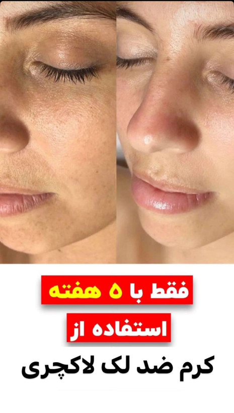 کرم ضد لک لاکچری کوئین