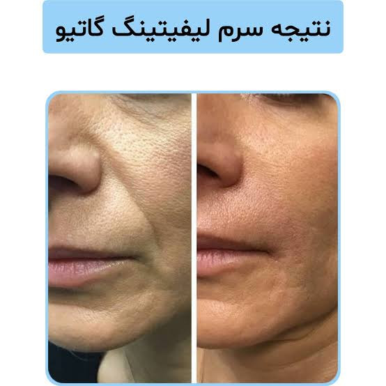 سرم لیفتینگ صورت گاتیو