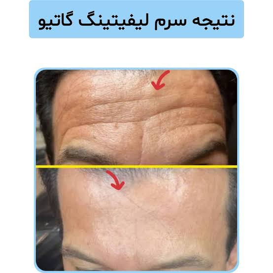سرم لیفتینگ صورت گاتیو