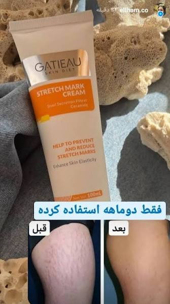 کرم ترکهای پوستی گاتیو (استرچ مارک)
