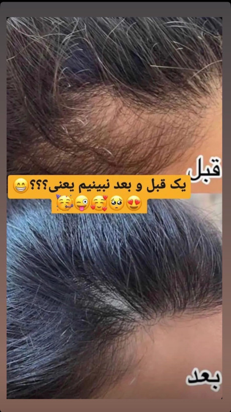شامپوی ضد ریزش و رویش مجدد هیرفرند